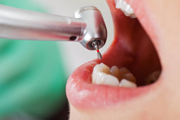 Best Emergency Root Canal Treatment in West Lafayette, OH
